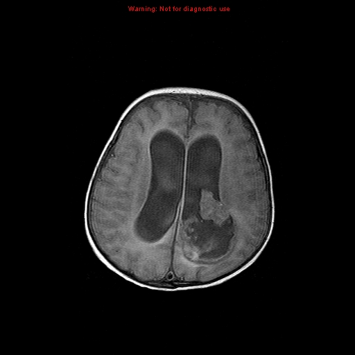 File:Atypical teratoid rhabdoid tumor (Radiopaedia 10712-11183 Axial FLAIR 6).jpg