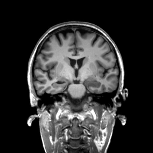 Autoimmune limbic encephalitis (Radiopaedia 30363-31005 Coronal T1 31).jpg