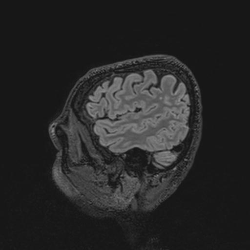 Autoimmune limbic encephalitis (Radiopaedia 30363-31005 Sagittal FLAIR 128).jpg