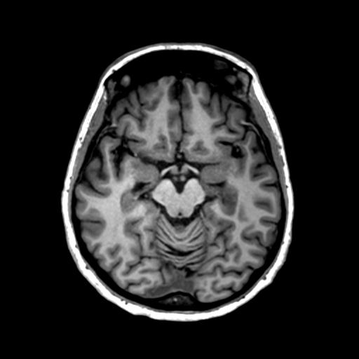 Autoimmune limbic encephalitis (Radiopaedia 30363-31005 T1 Axial 1mm 64).jpg