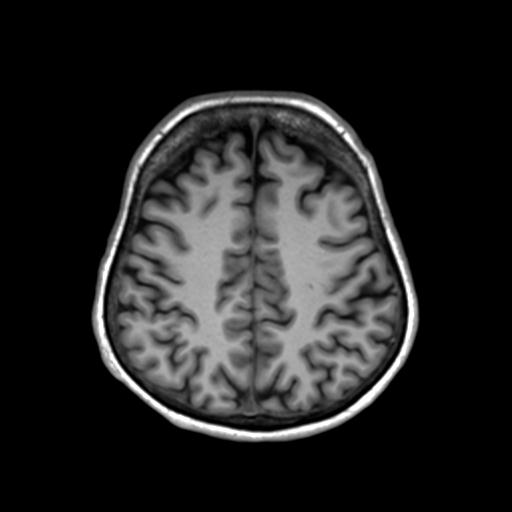 Autoimmune limbic encephalitis (Radiopaedia 30363-31005 T1 Axial 3mm 37).jpg