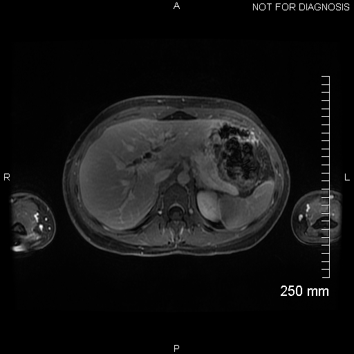 Autoimmune pancreatitis (Radiopaedia 88443-105101 A 48).jpg
