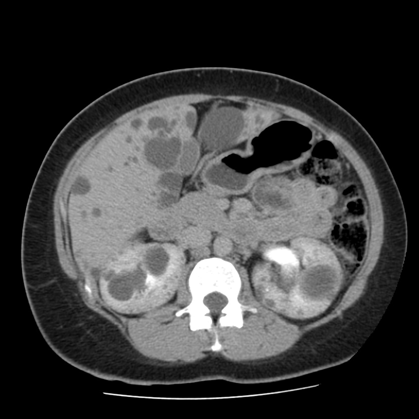 Autosomal dominant polycystic kidney disease (Radiopaedia 23061-23093 C+ delayed 27).jpg