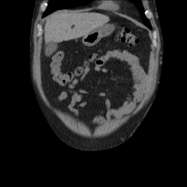 File:Autosomal dominant polycystic kidney disease (Radiopaedia 36539-38101 C 14).jpg