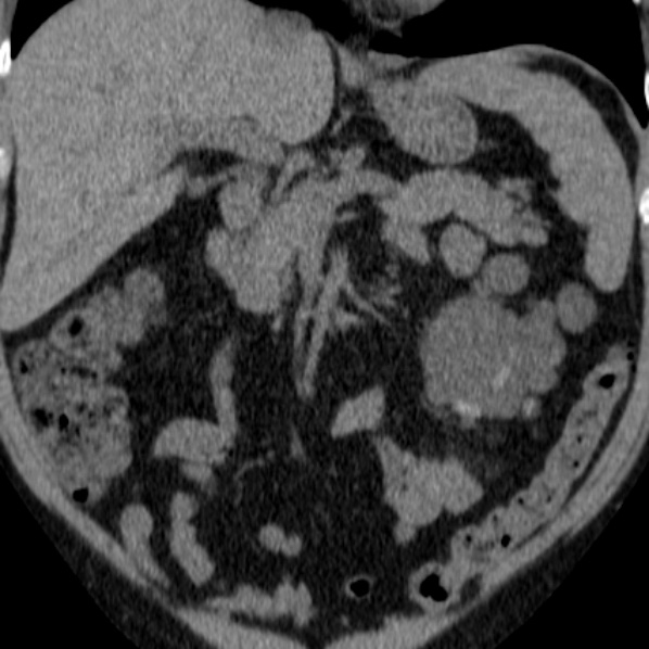 File:Autosomal dominant polycystic kidney disease (Radiopaedia 36539-38101 Coronal non-contrast 10).jpg