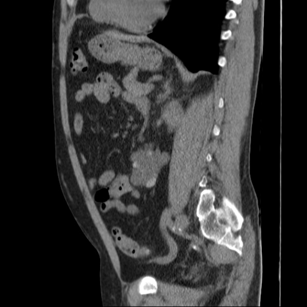 File:Autosomal dominant polycystic kidney disease (Radiopaedia 36539-38101 D 52).jpg