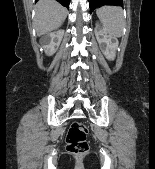 Autosomal dominant polycystic kidney disease (Radiopaedia 38189-40194 Coronal C+ delayed 85).jpg