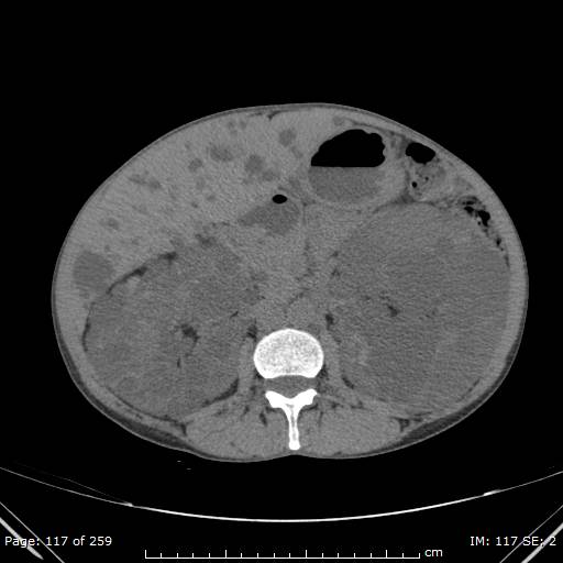Autosomal dominant polycystic kidney disease (Radiopaedia 44122-47684 Axial non-contrast 42).jpg