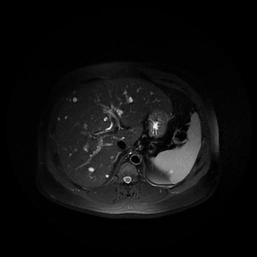 File:Autosomal dominant polycystic kidney disease (Radiopaedia 50259-55611 Axial T2 fat sat 12).jpg