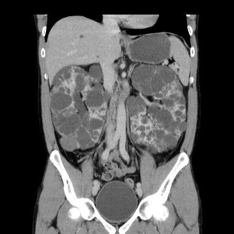 Autosomal dominant polycystic kidney disease (Radiopaedia 66349-75582 A 38).jpg