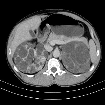 Autosomal dominant polycystic kidney disease (Radiopaedia 66349-75582 B 29).jpg
