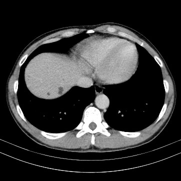 Autosomal dominant polycystic kidney disease (Radiopaedia 66349-75582 B 5).jpg
