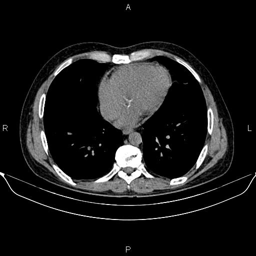Autosomal dominant polycystic kidney disease (Radiopaedia 87830-104287 Axial non-contrast 5).jpg