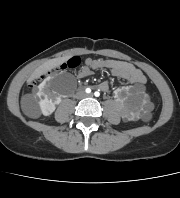 Autosomal dominant polycystic kidney disease - early onset (Radiopaedia 40734-43387 B 43).jpg