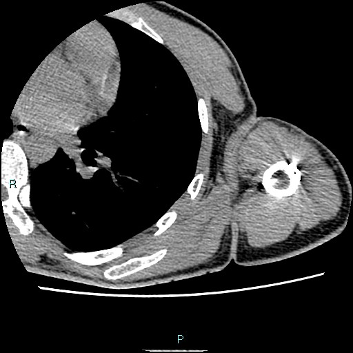 File:Avascular necrosis after fracture dislocations of the proximal humerus (Radiopaedia 88078-104653 D 79).jpg
