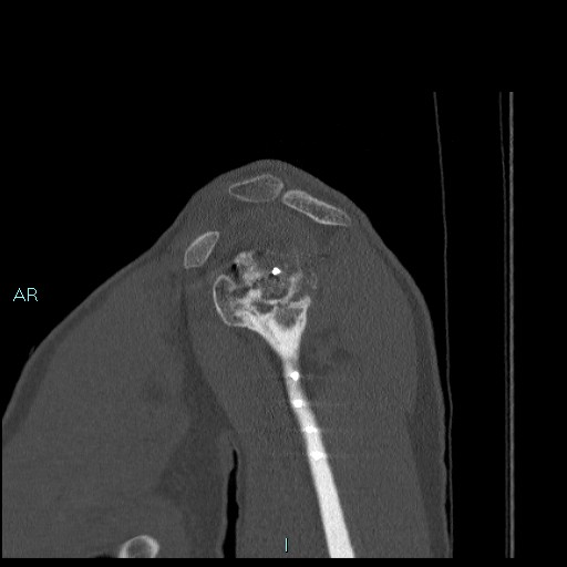 Avascular necrosis after fracture dislocations of the proximal humerus (Radiopaedia 88078-104655 Sagittal bone window 25).jpg