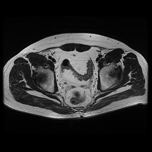 File:Avascular necrosis of the hip (Radiopaedia 61503-69465 T2 13).jpg