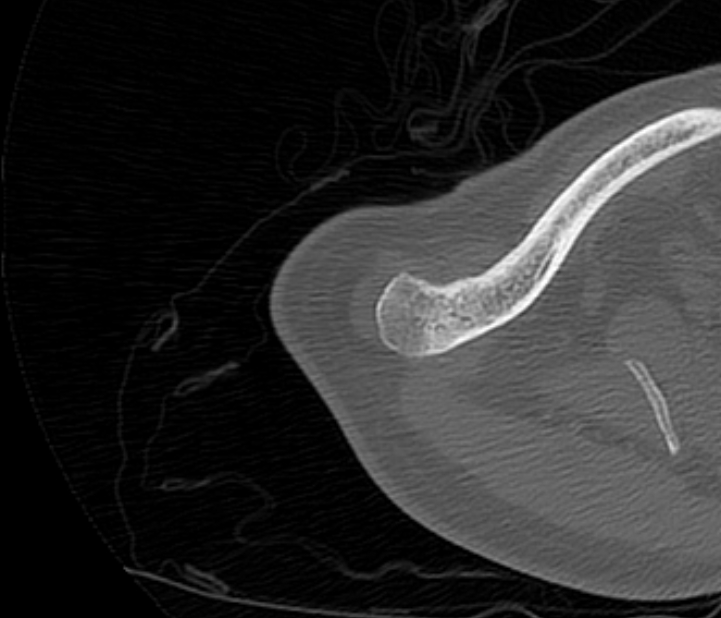 Avulsion fracture - greater tuberosity of humerus (Radiopaedia 71216-81514 Axial bone window 5).jpg