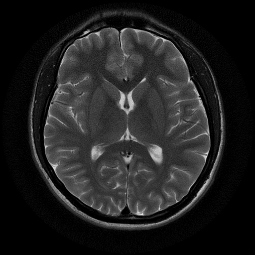 File:Azygos anterior cerebral artery (Radiopaedia 17059-16756 Axial T2 12).jpg