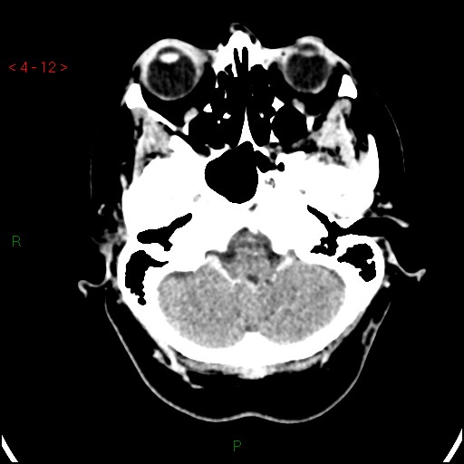 Azygos anterior cerebral artery (Radiopaedia 51987-57833 A 12).jpg