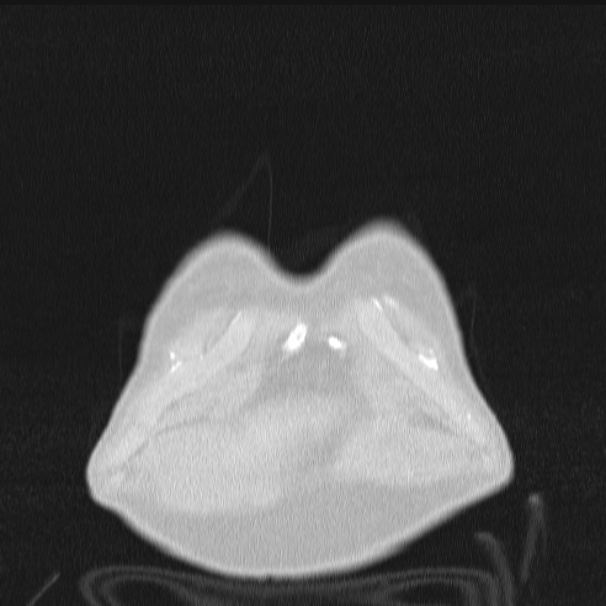 Azygos lobe (Radiopaedia 38259-40275 Coronal lung window 5).jpg
