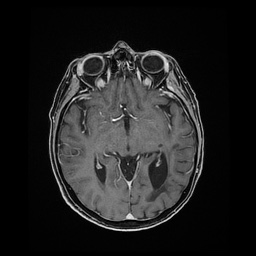 Balo concentric sclerosis (Radiopaedia 53875-59982 Axial LAVA C+ 121).jpg