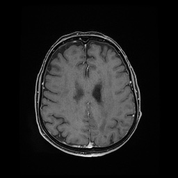 File:Balo concentric sclerosis (Radiopaedia 53875-59982 Axial LAVA C+ 176).jpg