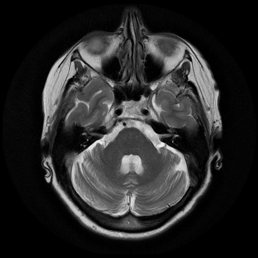 File:Balo concentric sclerosis (Radiopaedia 53875-59982 Axial T2 7).jpg
