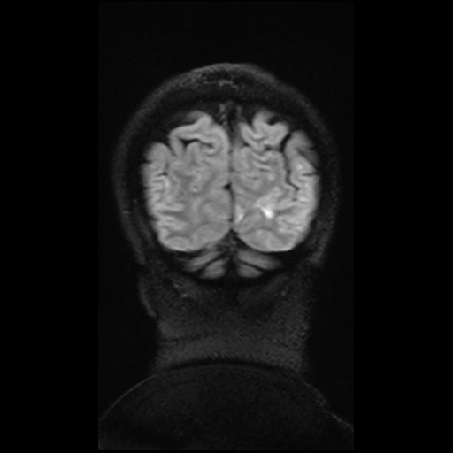 Balo concentric sclerosis (Radiopaedia 53875-59982 Coronal FLAIR 11).jpg