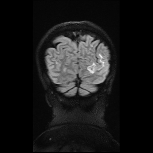 Balo concentric sclerosis (Radiopaedia 53875-59982 Coronal FLAIR 12).jpg