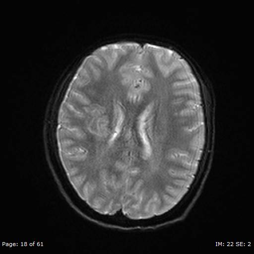 File:Balo concentric sclerosis (Radiopaedia 61637-69636 Axial DWI 18).jpg
