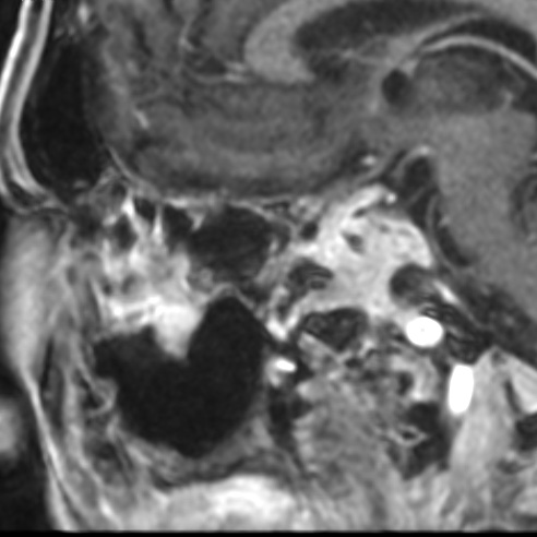 File:Basal cell carcinoma (periorbital) (Radiopaedia 55179-61559 F 18).jpg
