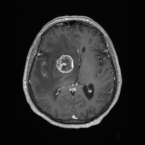 Basal ganglia metastasis (Radiopaedia 78928-91828 Axial T1 C+ 37).png