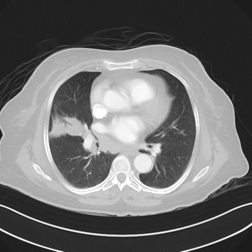 Basal ganglia metastasis (Radiopaedia 78928-91832 B 25).png