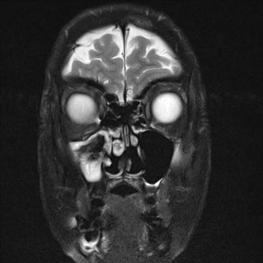 File:Base of skull chondrosarcoma (Radiopaedia 30410-31070 Coronal T2 fat sat 6).jpg