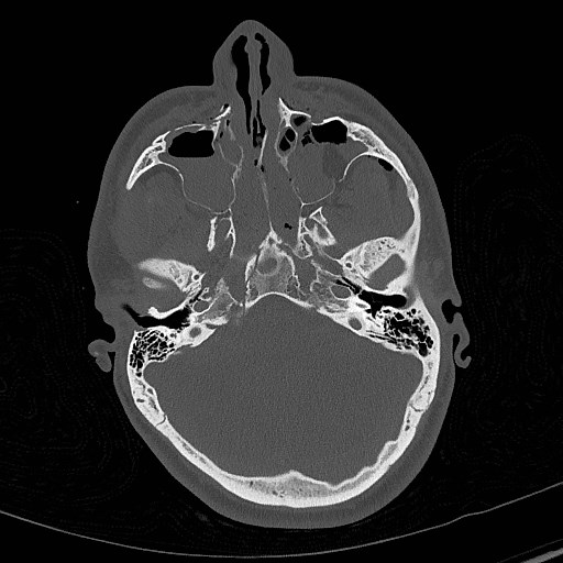 File:Base of skull fracture with bilateral Le Fort fractures (Radiopaedia 47094-51638 Axial bone window 28).jpg