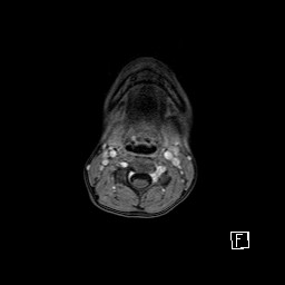 Base of skull rhabdomyosarcoma (Radiopaedia 32196-33142 T1 C+ fat sat 3).jpg