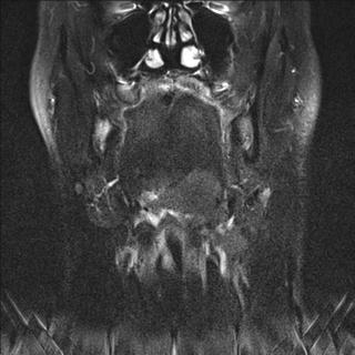 File:Base of tongue squamous cell carcinoma (Radiopaedia 31174-31884 Coronal T2 fat sat 14).jpg
