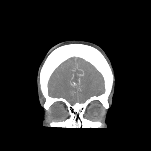 Basilar and bilateral vertebral artery occlusion (Radiopaedia 45592-49723 B 19).png