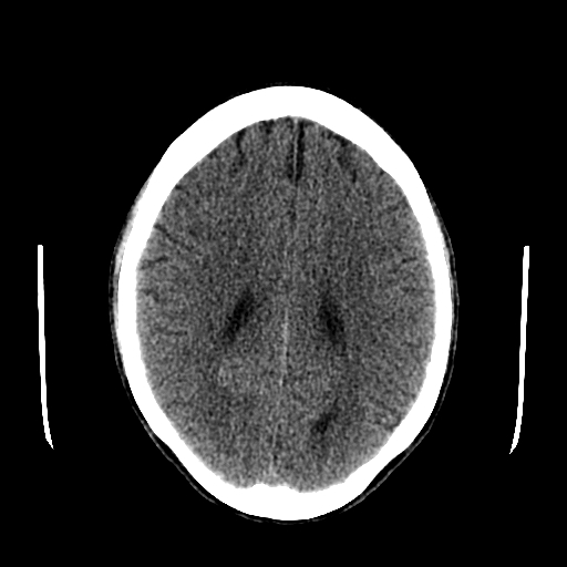 File:Basilar artery perforator aneurysm (Radiopaedia 82455-96597 Axial non-contrast 23).jpg
