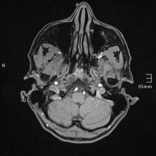 Basilar artery perforator aneurysm (Radiopaedia 82455-99523 F 7).jpg
