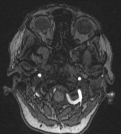 Basilar tip aneurysm (Radiopaedia 26504-26632 MRA 18).jpg