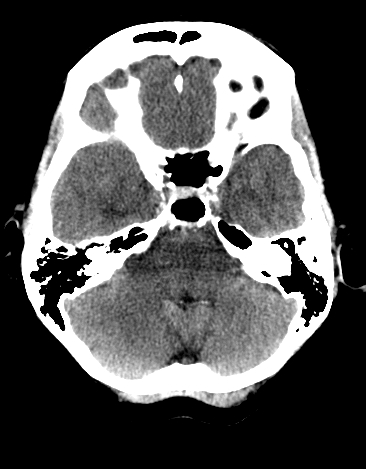 File:Basilar tip aneurysm with coiling (Radiopaedia 53912-60033 Axial non-contrast 7).jpg