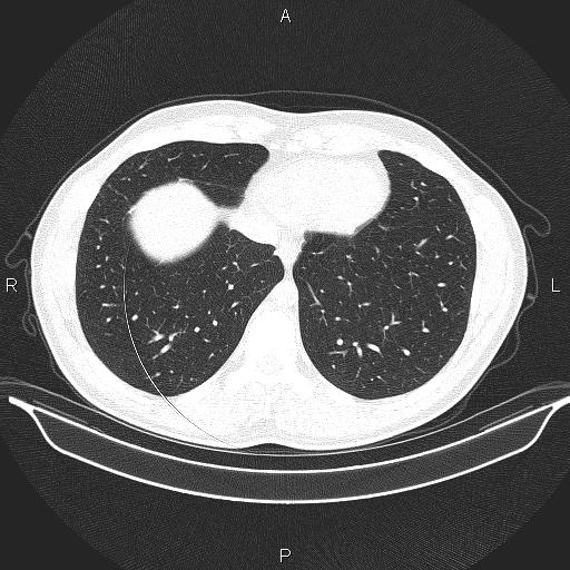 Beam hardening and ring artifacts (Radiopaedia 85323-100915 Axial lung window 59).jpg