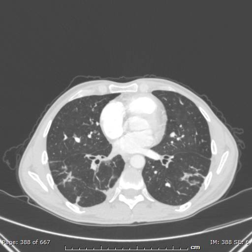 Behçet disease (Radiopaedia 44247-47889 Axial lung window 52).jpg