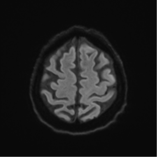 Behavioral variant frontotemporal dementia and late onset schizophrenia (Radiopaedia 52197-58083 Axial DTI Trace W 49).png