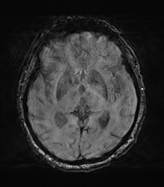 File:Behavioral variant frontotemporal dementia and late onset schizophrenia (Radiopaedia 52197-58083 Axial SWI 35).png