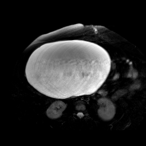 File:Benign seromucinous cystadenoma of the ovary (Radiopaedia 71065-81300 T2 SPAIR 28).jpg