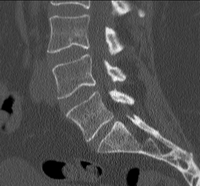 Bertolotti syndrome (Radiopaedia 24864-25128 Sagittal bone window 25).jpg