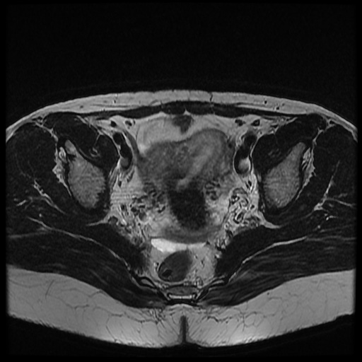 File:Bicornuate uterus (Radiopaedia 51676-57472 Axial T2 18).jpg